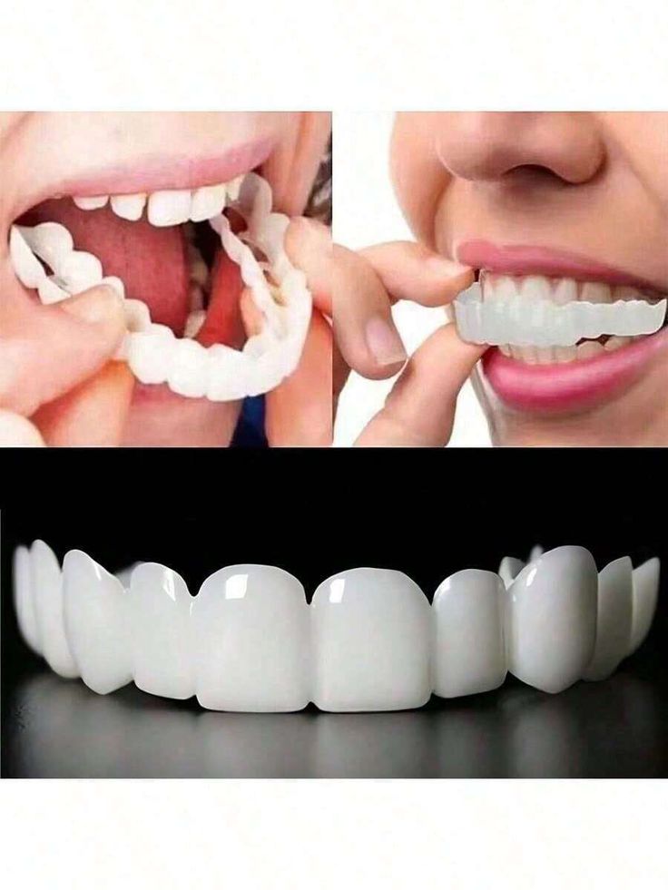 Snap in Teeth for Men and Women